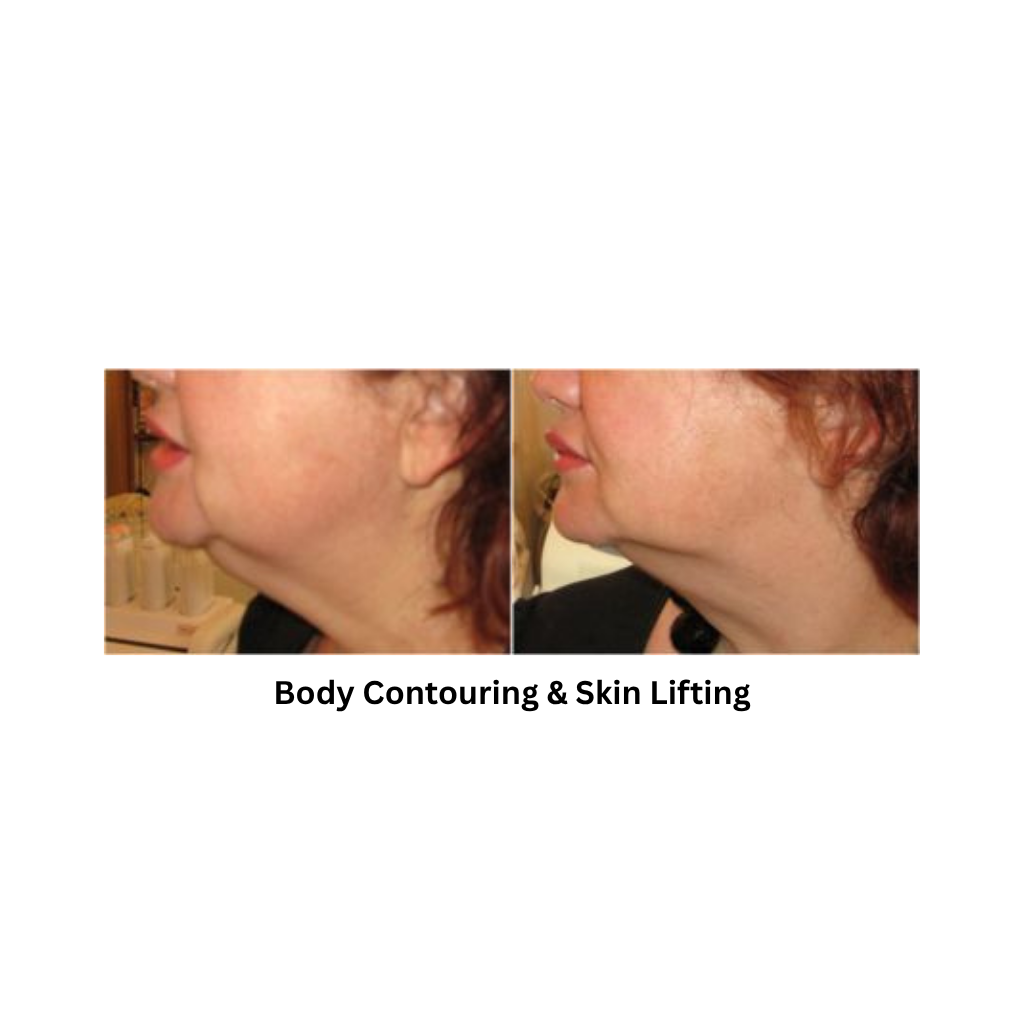 Body Shape RF Body Contouring & Skin Rejuvenation System - Image 4