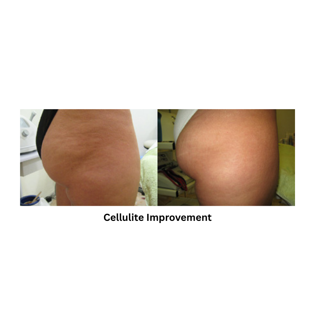 Body Shape RF Body Contouring & Skin Rejuvenation System - Image 5
